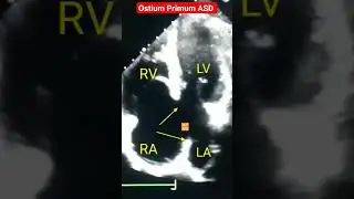 Ostium Primum ASD l Hole in Heart l Echo #asd #Echo #shorts