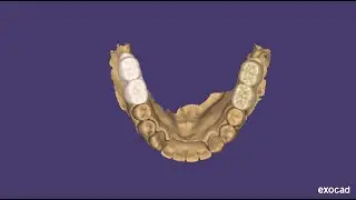 Upper posterior (molars) designing for pmma prosthesis in Exocad elefsina  - DIGITAL DENTISTRY