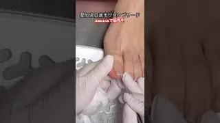 巻き爪ケアフレックスプレートで巻き爪矯正