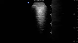 Absent Lung Sliding | Clinical Image
