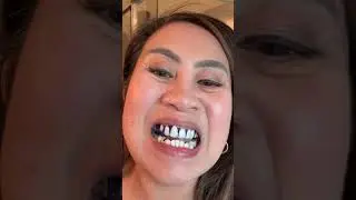 Veneers who #whiteningstrips #drdent #yellowteeth #teethinghacks #tiktokshopcreatorpick