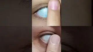 white eye😲#eye#white#trend