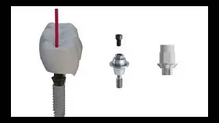Attention when choosing abutment for screw retained restorations