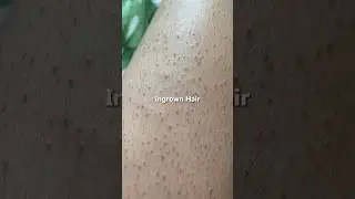 How to get rid of ingrown hair, keratosis pilaris, strawberry skin at home #dermatologist #skincare