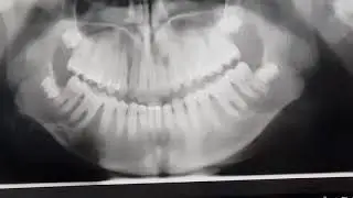 الاهمية الكبيرة للاشعة الشاملة لعموم الاسنان .  The Greate Value of OPG in Ortho.