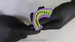Mock-Up com resina bisacrílica – da confecção do guia de silicone à instalação em boca