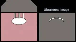 Clean posterior acoustic shadowing on ultrasound