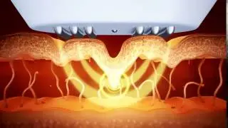 3Deep - skin tightening device using Radio Frequency technology