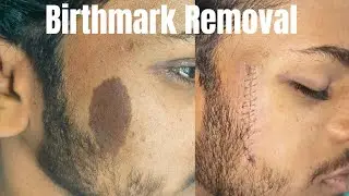 Birthmark removal surgery| scarless birthmark Removal surgery in Ranchi | best birthmark Removal