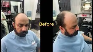 Best Hair Patch For Men In Rawalpindi | Good Looking Hair Patch For Men | Falak Hair Club | Sufyan