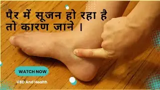 Lymphatic Filariasis Diagnosis | फाइलेरिया के सूजन को कैसे पहचाने