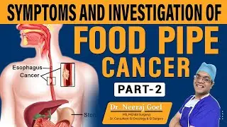 भोजन नली के कैंसर के लक्षण | Symptoms and Investigation of Esophagus (food pipe) cancer