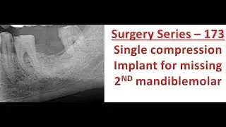 Single compression screw for second mandible molar