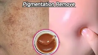Pigmentation, Dark Spots & Dull Skin Ke Liye Powerful Home Remedy | Instant Glow Pack