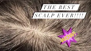 TYLER HAIR SYSTEM FROM LAVIVID | UNMATCHED NATURAL SCALP APPEARANCE