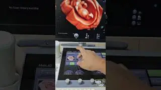 3D Pregnancy Tutorial || Ultrasound
