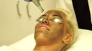 Carbon X Peel! Now Available EXCLUSIVELY at MetroMD! #PeelSeason with Sibley Scoles