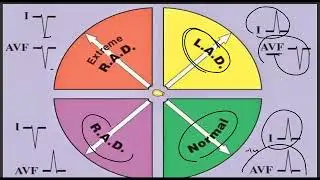 Cardiology MRCP - 08 - ECG changes - Axis Deviation - ST elevation Part 1
