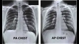 AP and PA view chest x-ray ( How to differentiate)