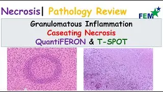 Granulomatous Inflammation | Caseating Necrosis, QuantiFERON & T-SPOT| Pathology Review | USMLE