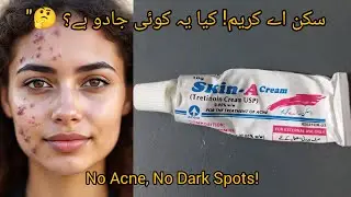 Skin A Cream Review | No Acne, No Dark Spots Real Results 😱