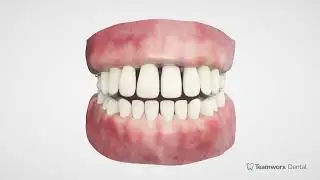 Flipper, Essix Retainer, or Screw Retained Temporary Crown