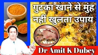 Osmf treatment in hindi , muh ke kam khulne ka upay , #dramitkdubey