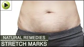 Skin Care - Stretch Marks - Natural Ayurvedic Home Remedies