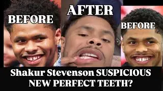 Shakur Stevenson SUSPICIOUS NEW PERFECT TEETH?#boxing #sports #shakurstevenson #boxer #teofimolopez 