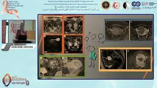 Uterine Leiomyosarcoma; when to suspect? - Prof. Basma Nabil Gadelhak