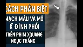 Phân biệt tổn thương mô kẽ và mạch máu ở đỉnh phổi | Xquang ngực thẳng