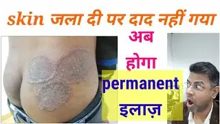 Fungal infection permanent treatment I Daad ka ilaj l Skin Care Clinic l Dr. ANIL MOHITE l MD