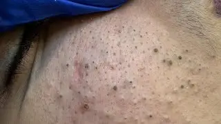 Soko's Morning Facial Care Routine (Deep Cleansing For Acne & Blackheads)
