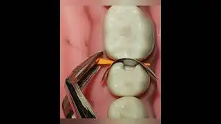 Phantom dental - premolar distal cavity sectional matrix
