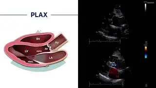 〖Echocardiography〗 Parasternal long axis view - dil. Aorta, AR, MR 🫀📖