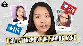 Does Acne Matter? ( Honest Talk About Acne )