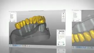 Dess Customised Abutments