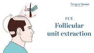 FUE - follicular unit extraction - Medical Tourism Mexico