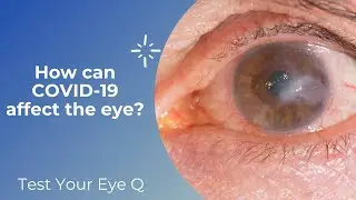 Test your EyeQ: How can COVID-19 affect the eye?