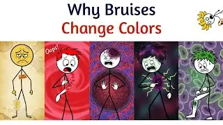 Why Bruises Change Colors
