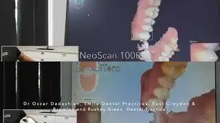 NeoScan 1000 vs iTero intraoral scanning
