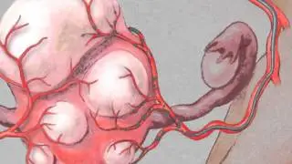 Uterine Artery Embolization (UAE)
