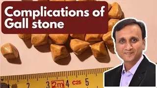 Ten Problems Due To Gall Bladder Stone