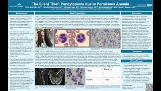 The Silent Thief: Pancytopenia due to Pernicious Anemia Case Presentation