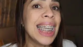 Brackets a los 40! Ligas de Ortodocia.