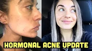 Hormonal Acne Update | Estroblock + Oil Cleansing Method