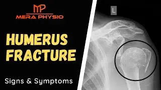 Humerus Fracture | Signs and Symptoms | In Hindi | Mera Physio