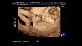 3D Echo 19 Weken Zwanger, met ingesproken uitleg