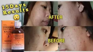 RDL BABY FACE Solution#3 (15 Days Results)