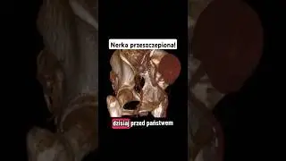 Case study - nerka przeszczepiona w TK - małoinwazyjny zabieg stentowania zwężonej tętnicy nerkowej.